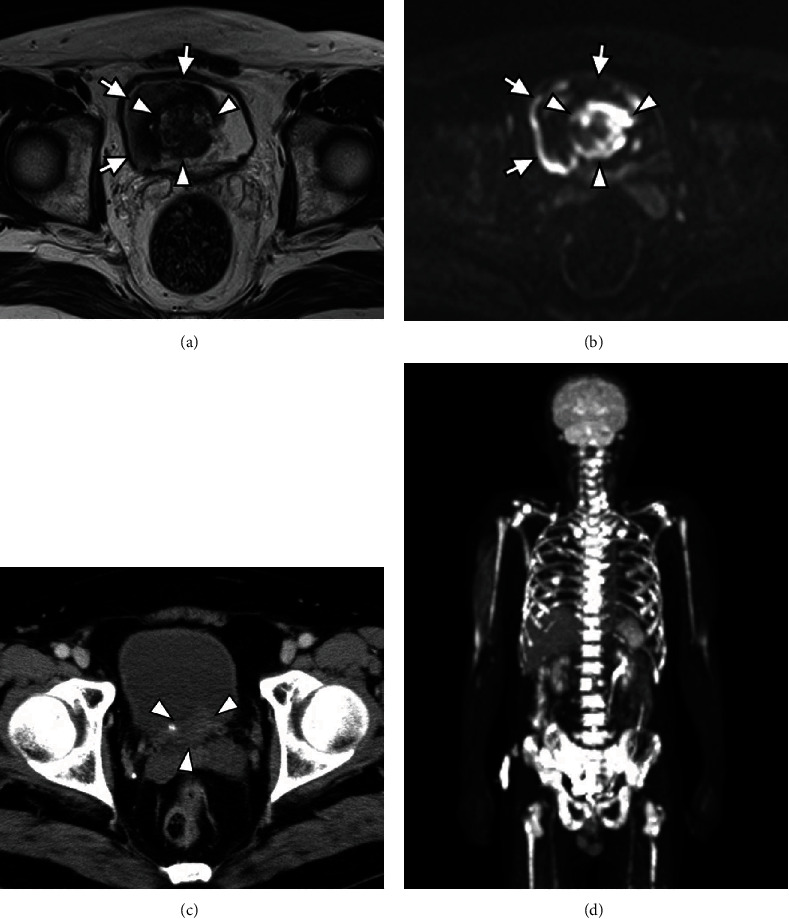 Plasmacytoid Urothelial Carcinoma of the Bladder That Manifests Disseminated Carcinomatosis of the Bone Marrow: A Case Report of Extremely Rapid Progression.