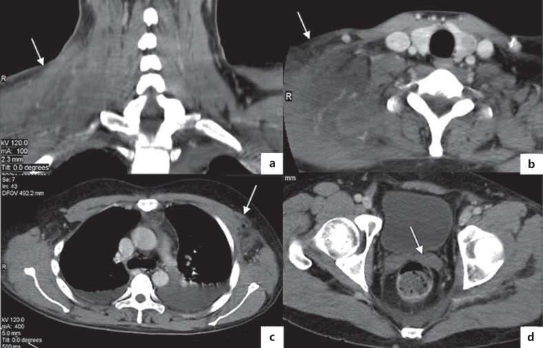 Acute Disseminated Panniculitis Associated with Alpha-1 Antitrypsin Deficiency.