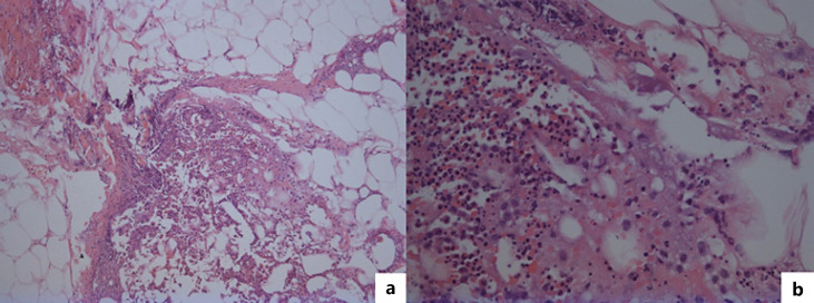 Acute Disseminated Panniculitis Associated with Alpha-1 Antitrypsin Deficiency.