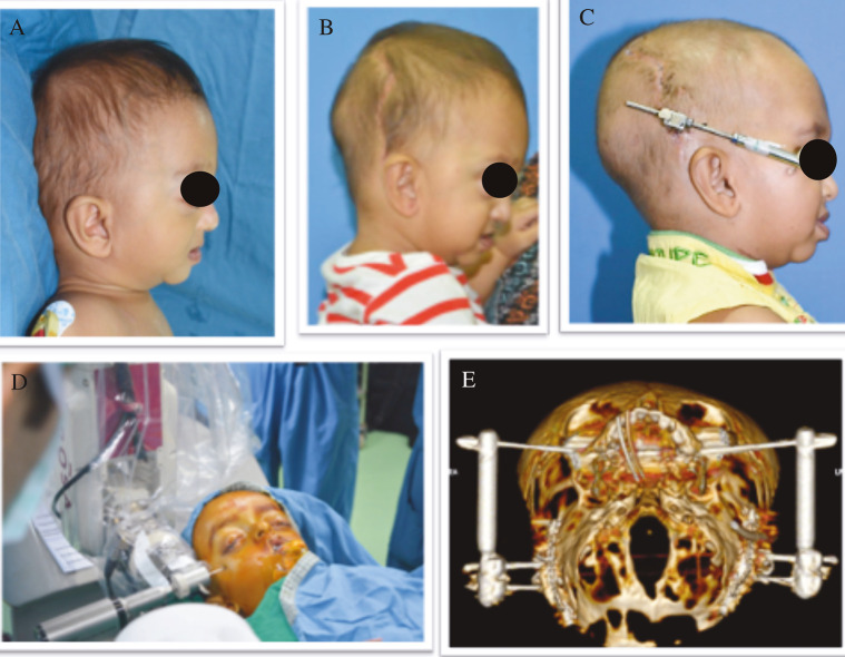 Multisuture and Syndromic Craniosynostoses: Simplifying the Complex.