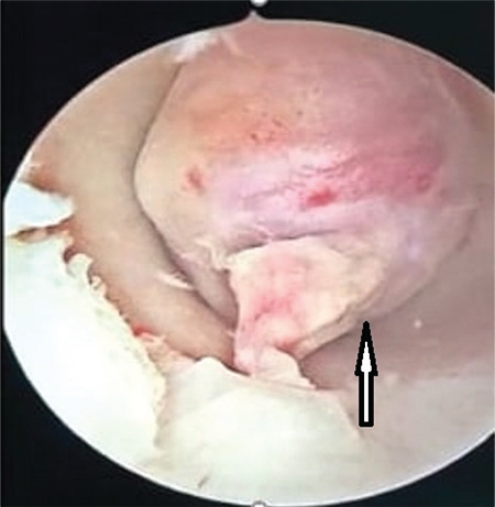 Advanced-stage Endometrial Stromal Sarcoma Presenting as Primary Infertility in a Young Nulligravida: A Case Report.