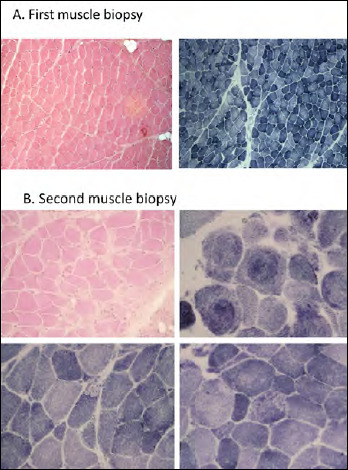 Congenital myopathy associated with a novel mutation in <i>MEGF10</i> gene, myofibrillar alteration and progressive course.