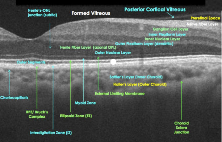 Retinal Ganglion Cell Complex in Alzheimer Disease: Comparing Ganglion Cell Complex and Central Macular Thickness in Alzheimer Disease and Healthy Subjects Using Spectral Domain-Optical Coherence Tomography.