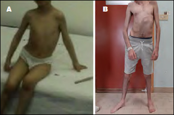 Congenital myopathy associated with a novel mutation in <i>MEGF10</i> gene, myofibrillar alteration and progressive course.