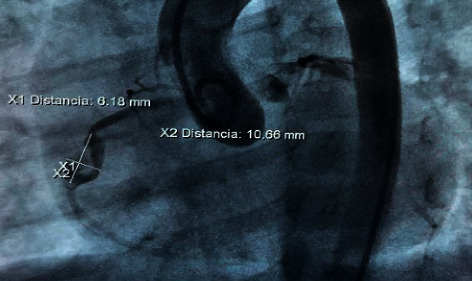 Giant Partially Thrombosed Coronary Aneurysm in Multisystem Inflammatory Syndrome Associated with SARS-CoV-2 in Children.