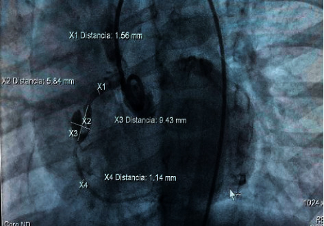 Giant Partially Thrombosed Coronary Aneurysm in Multisystem Inflammatory Syndrome Associated with SARS-CoV-2 in Children.