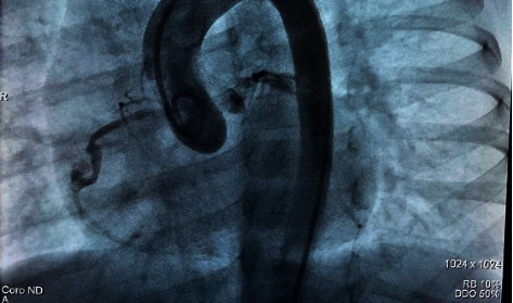 Giant Partially Thrombosed Coronary Aneurysm in Multisystem Inflammatory Syndrome Associated with SARS-CoV-2 in Children.