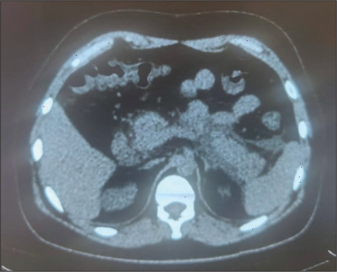 UNUSUAL CASES OF ACUTE PANCREATITIS IN PATIENTS WITH COVID-19.