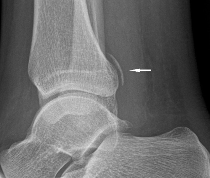 Avulsion Fracture of the Posterior Tibiofibular Syndesmosis.