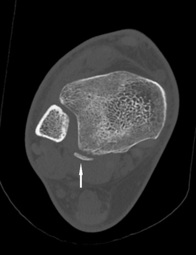 Avulsion Fracture of the Posterior Tibiofibular Syndesmosis.