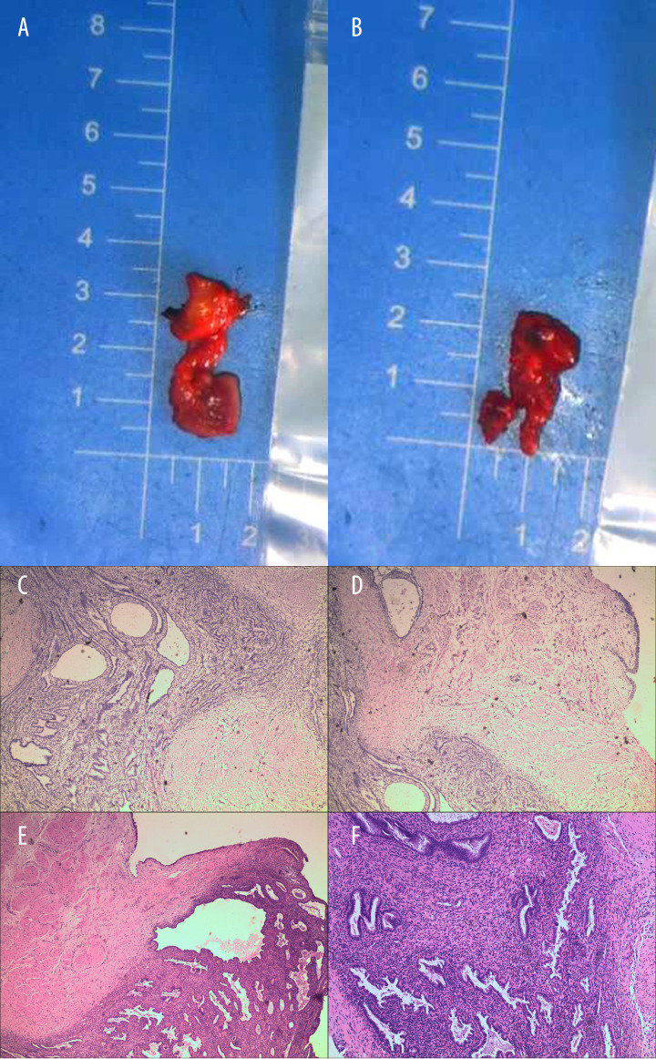 Severe Ureteral Endometriosis Complicated with Hydronephrosis: A Case Report.