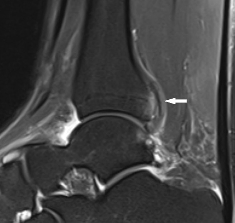 Avulsion Fracture of the Posterior Tibiofibular Syndesmosis.