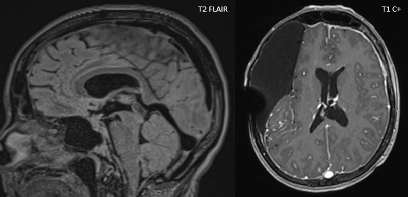 Cervical Myelopathy Caused by Engorged Epidural Cervical Plexus Associated with Iatrogenic Intracranial Hypotension.