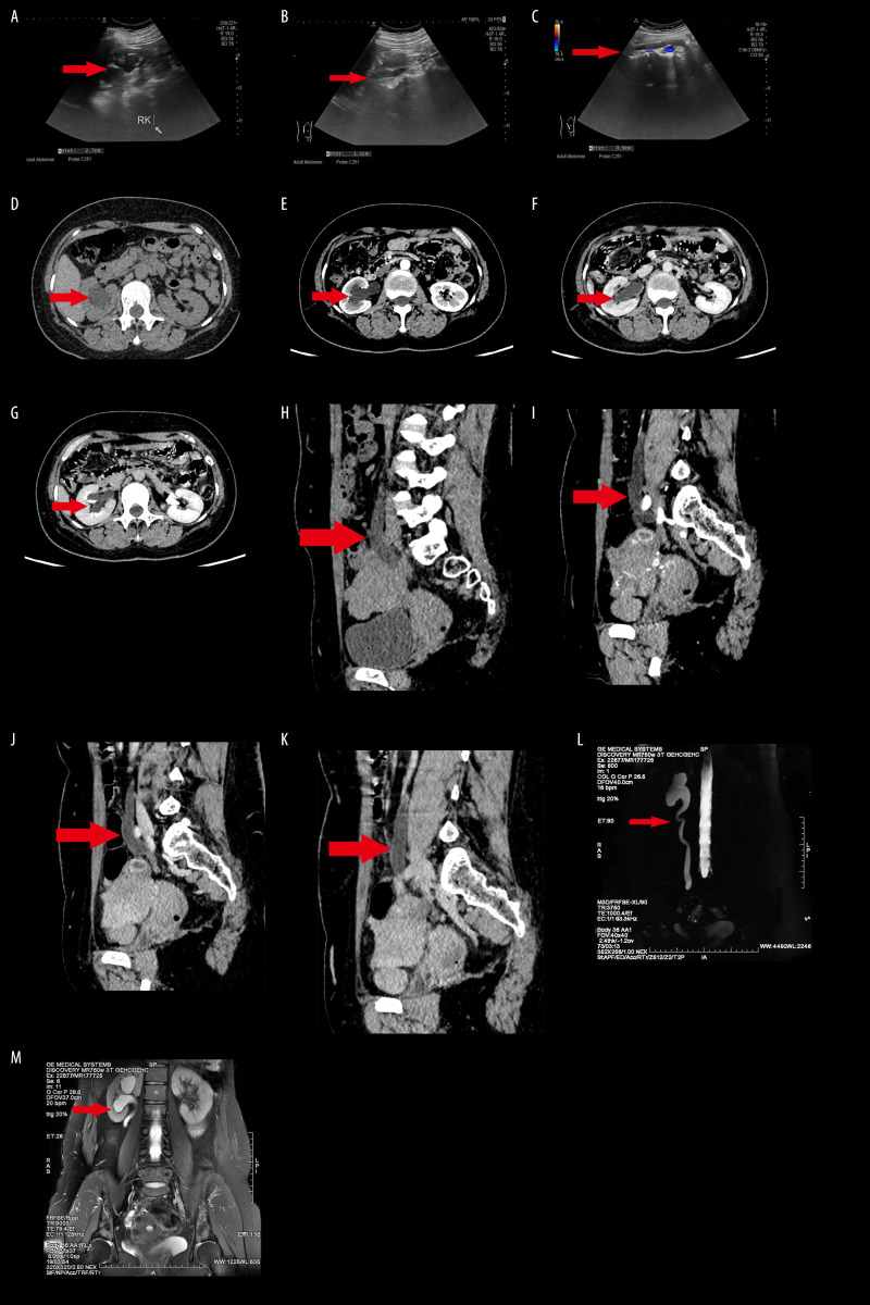 Severe Ureteral Endometriosis Complicated with Hydronephrosis: A Case Report.