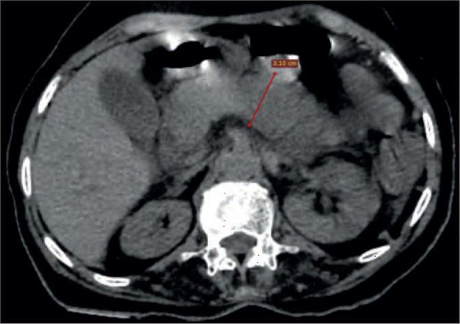 UNUSUAL CASES OF ACUTE PANCREATITIS IN PATIENTS WITH COVID-19.