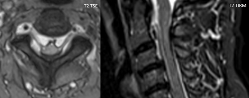 Cervical Myelopathy Caused by Engorged Epidural Cervical Plexus Associated with Iatrogenic Intracranial Hypotension.