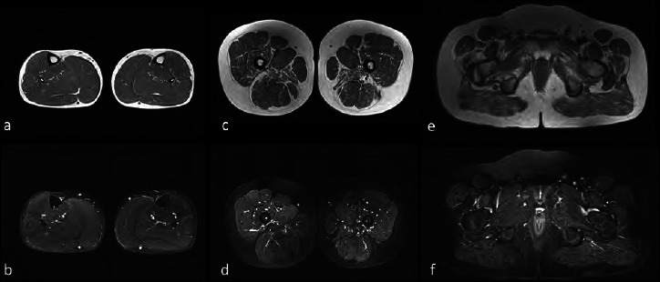 Good response to the late treatment with ataluren in a boy with Duchenne muscular dystrophy: could the previous mild course of the disease have affected the outcome?