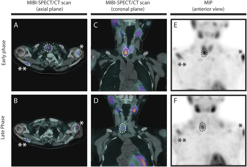 Brown tumor mimicking metastases-the late manifestation of hyperparathyroidism.