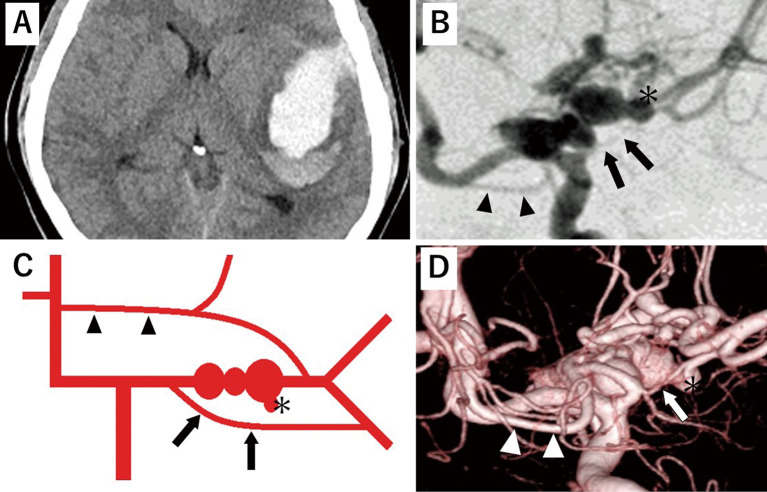 Cerebrovascular Treatment with Superselective Balloon Test Occlusion for Multiple Cerebral Aneurysms Associated with Middle Cerebral Artery Anomaly: A Case Report.