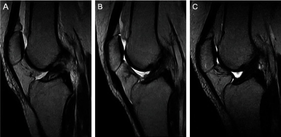 Primary Repair versus Reconstruction in Patients with Bilateral Anterior Cruciate Ligament Injuries: What Do Patients Prefer?