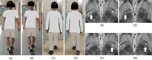 Two Cases of Monozygotic Twins with Early-onset Isolated (DYT1) Dystonia Effectively Treated with Bilateral Globus Pallidus Internus Stimulation.