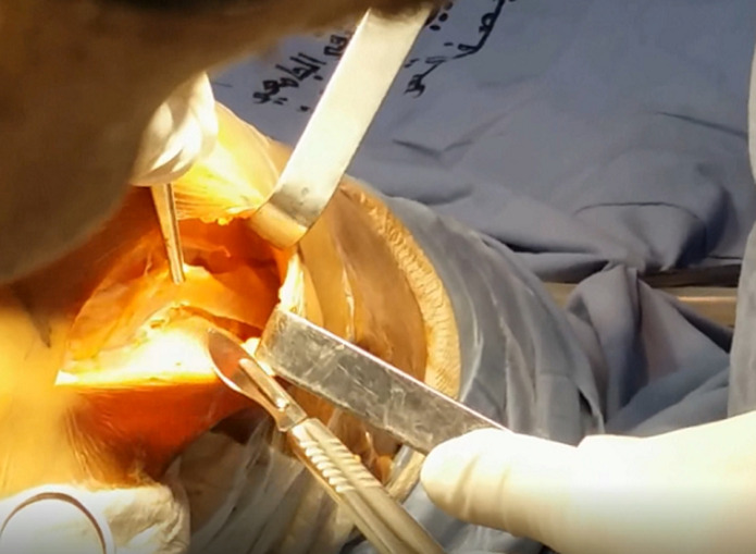 [Anterior cruciate ligament reconstruction using Mac Intosh technique modified by Jaeger: a retrospective study of 80 cases in the Department of Orthopedics and Traumatology at the Habib Bourguiba University Hospital, Sfax, Tunisia].