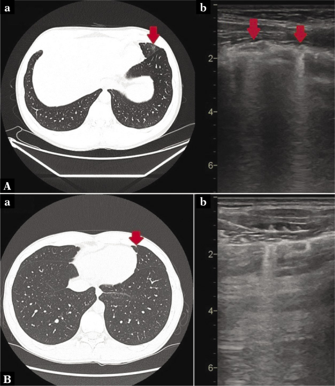 Lung Ultrasonography and Computed Tomography Comparison in Convalescent Athletes after Sars-CoV-2 Infection - A Preliminary Study.