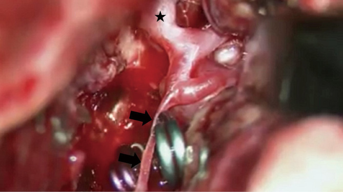 Cerebrovascular Treatment with Superselective Balloon Test Occlusion for Multiple Cerebral Aneurysms Associated with Middle Cerebral Artery Anomaly: A Case Report.