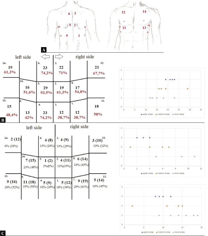 Lung Ultrasonography and Computed Tomography Comparison in Convalescent Athletes after Sars-CoV-2 Infection - A Preliminary Study.