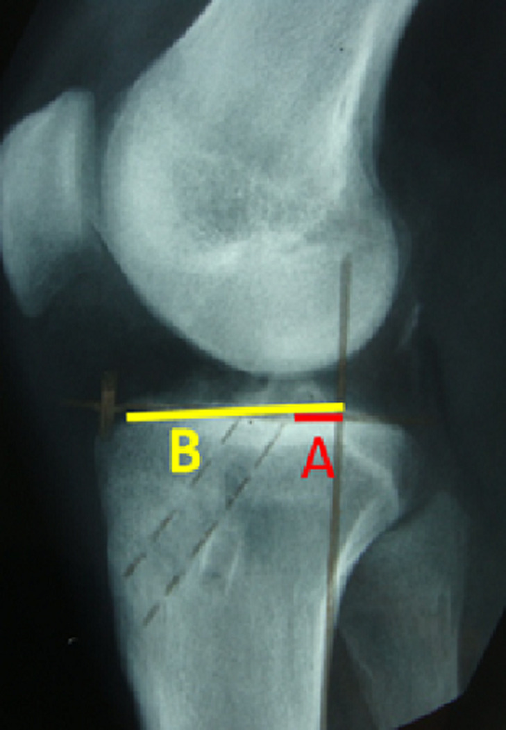 [Anterior cruciate ligament reconstruction using Mac Intosh technique modified by Jaeger: a retrospective study of 80 cases in the Department of Orthopedics and Traumatology at the Habib Bourguiba University Hospital, Sfax, Tunisia].