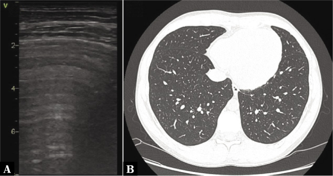 Lung Ultrasonography and Computed Tomography Comparison in Convalescent Athletes after Sars-CoV-2 Infection - A Preliminary Study.