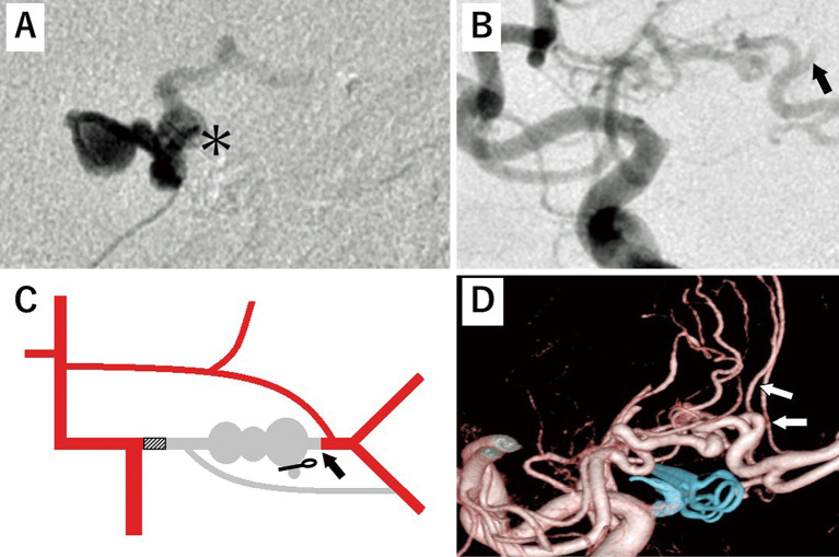 Cerebrovascular Treatment with Superselective Balloon Test Occlusion for Multiple Cerebral Aneurysms Associated with Middle Cerebral Artery Anomaly: A Case Report.