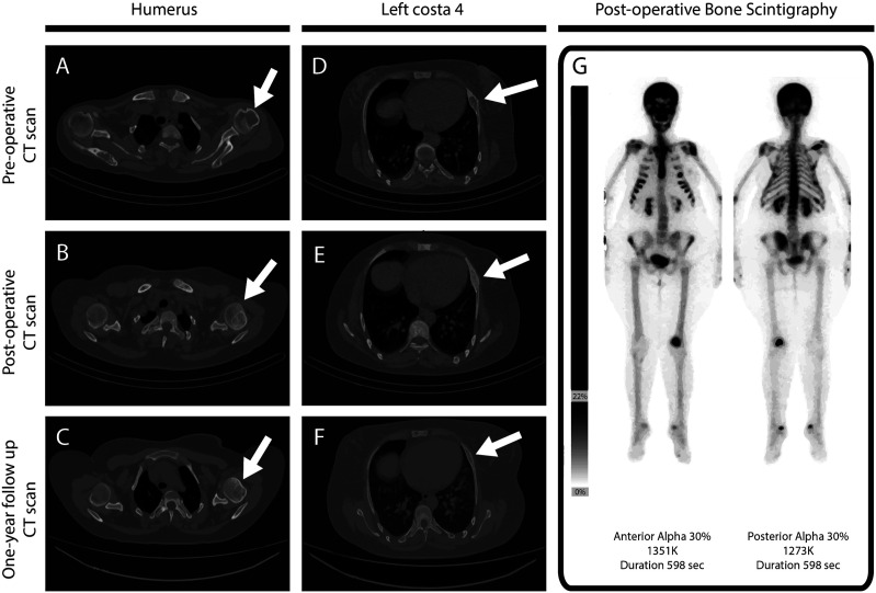 Brown tumor mimicking metastases-the late manifestation of hyperparathyroidism.