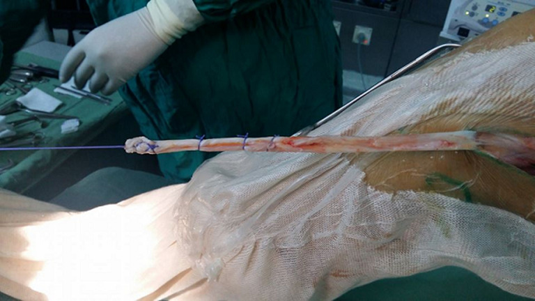 [Anterior cruciate ligament reconstruction using Mac Intosh technique modified by Jaeger: a retrospective study of 80 cases in the Department of Orthopedics and Traumatology at the Habib Bourguiba University Hospital, Sfax, Tunisia].