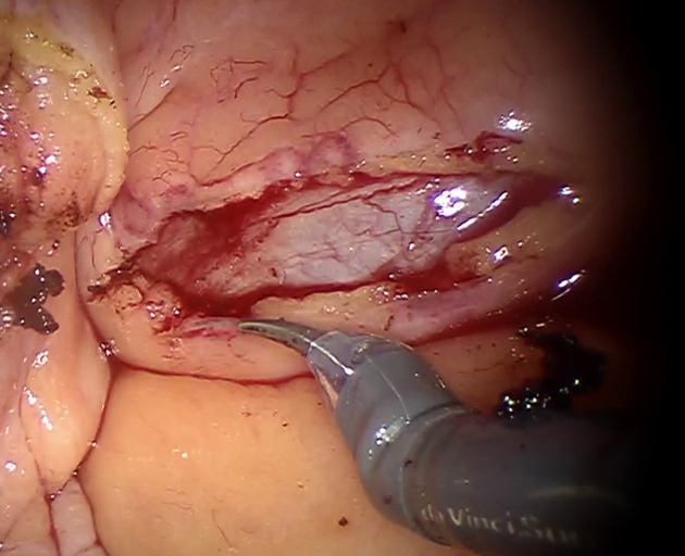 Robotic Local Fat Extirpation and Ureteric Reimplantation for Pelvic Lipomatosis with Ureteric Obstruction: Technical Considerations.