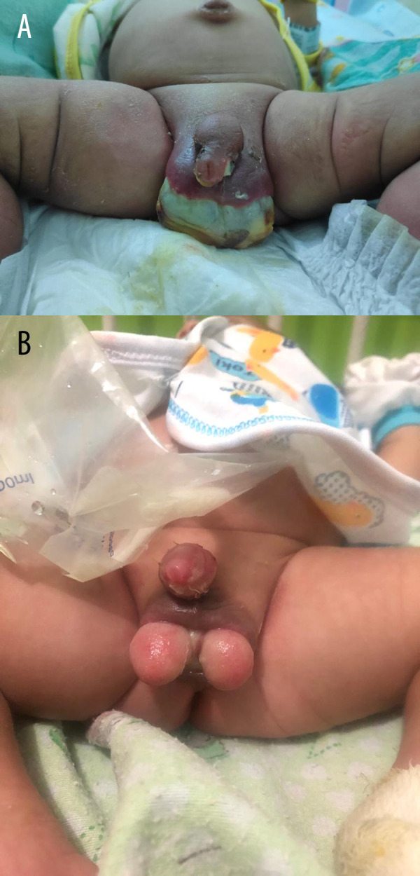 A 30-Day-Old Infant with Necrotizing Fasciitis of the Perineal Region Involving the Scrotum Due to Methicillin-Resistant Staphylococcus aureus (MRSA) and Extended-Spectrum β-Lactamase (ESBL)-Producing Klebsiella pneumoniae: A Case Report.