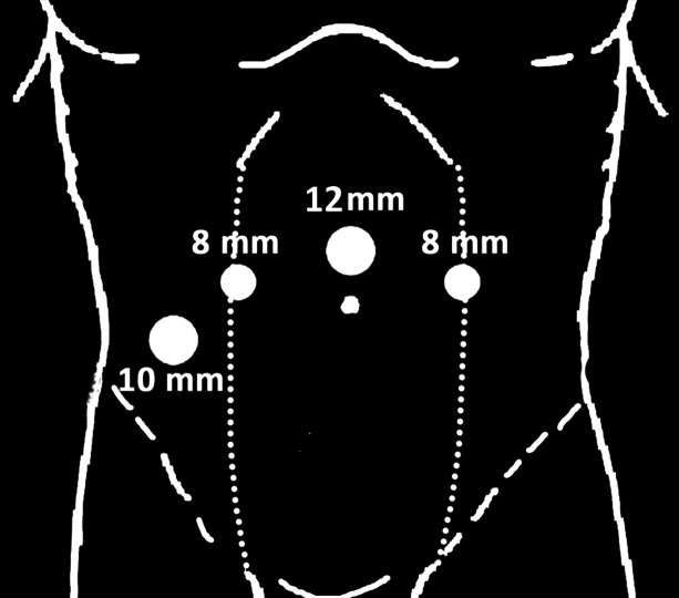 Robotic Local Fat Extirpation and Ureteric Reimplantation for Pelvic Lipomatosis with Ureteric Obstruction: Technical Considerations.