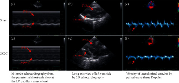 Syndecan-4 is More Sensitive in Detecting Hypertensive Left Ventricular Diastolic Dysfunction in 2K2C Rats.