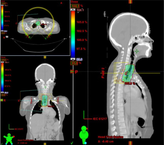 Mucoepidermoid carcinoma of the trachea in a 9-year-old male child: case report and review of literature.