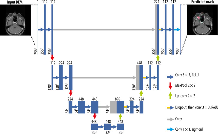 Segmentation of orbital and periorbital lesions detected in orbital magnetic resonance imaging by deep learning method.