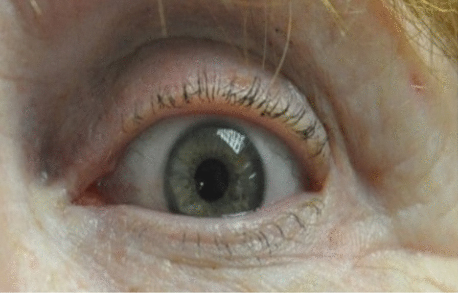 How I do it: lateral canthal web revision-single Z-plasty technique.
