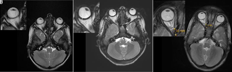Increased ocular wall thickness and decreased globe volume in children with mucopolysaccharidosis type VI.