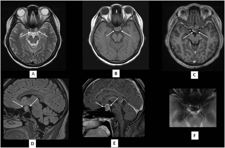 Pituitary apoplexy after COVID-19 vaccination: A case report