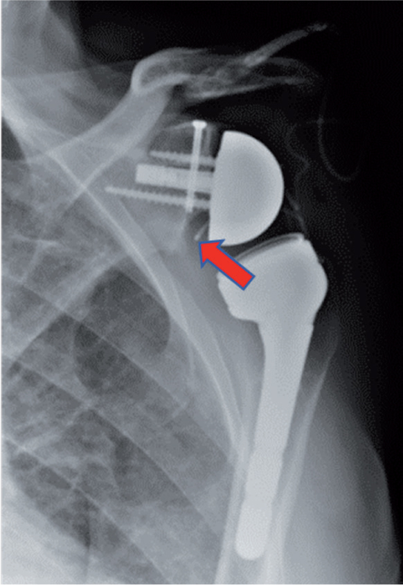 Salphage: salvage bacteriophage therapy for a recalcitrant Klebsiella pneumoniae prosthetic shoulder infection - a case report.