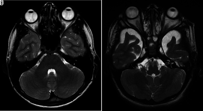 Increased ocular wall thickness and decreased globe volume in children with mucopolysaccharidosis type VI.