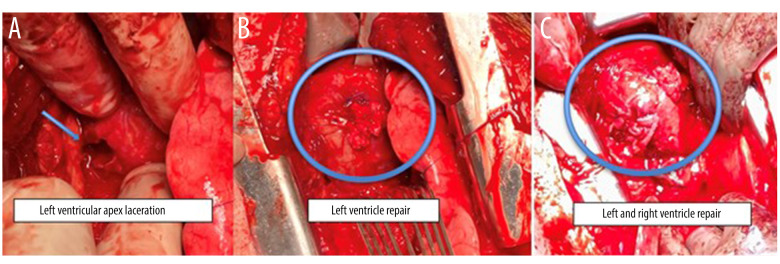 Use of a Modified ABTHERA ADVANCE™ Open Abdomen Dressing with Intrathoracic Negative-Pressure Therapy for Temporary Chest Closure After Damage Control Thoracotomy.