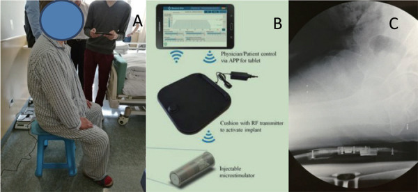 Treatment of stress urinary incontinence with a percutaneously implantable wireless microstimulator device (NuStim<sup>®</sup>) plus pelvic floor muscle exercises: a pilot study.