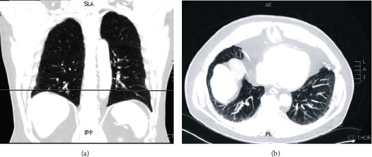 Navigational Bronchoscopy with Cryobiopsy for Diagnosis of ILD.