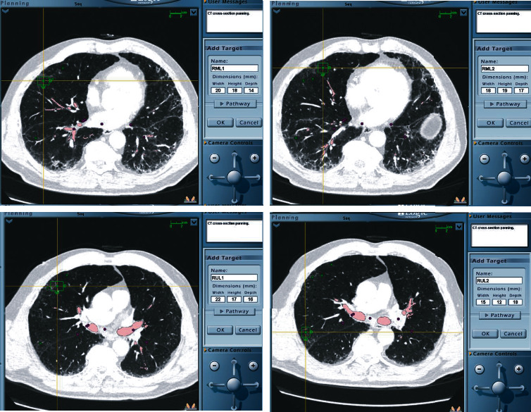 Navigational Bronchoscopy with Cryobiopsy for Diagnosis of ILD.