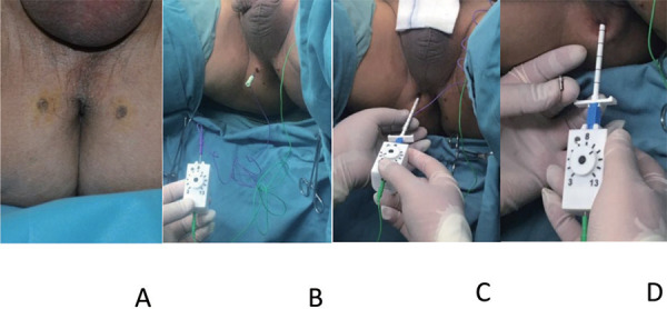 Treatment of stress urinary incontinence with a percutaneously implantable wireless microstimulator device (NuStim<sup>®</sup>) plus pelvic floor muscle exercises: a pilot study.